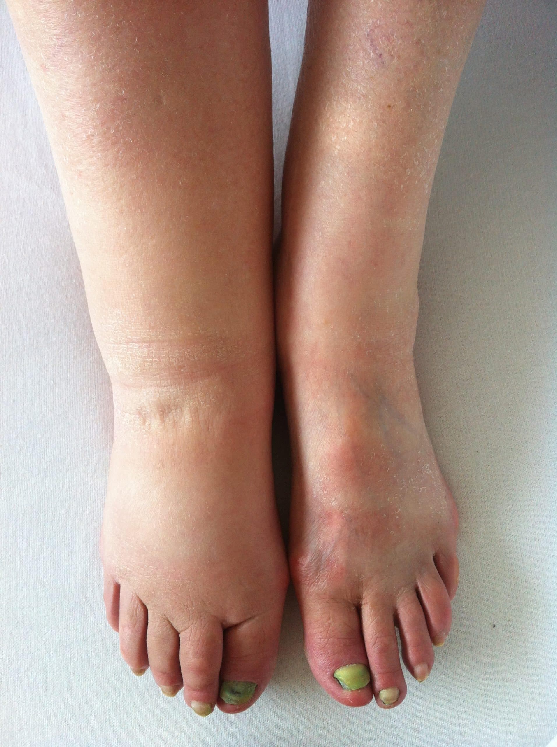 Manual lymphatic drainage being performed on a swollen limb