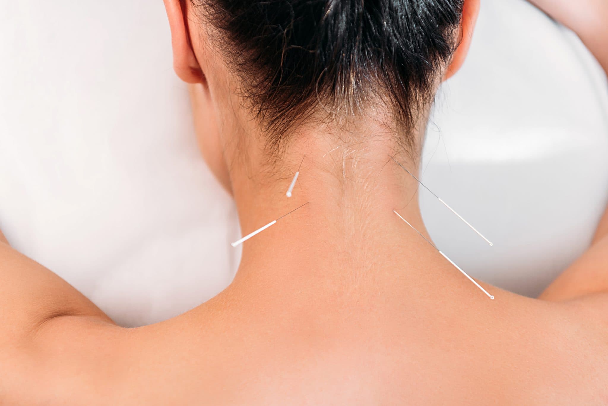 Dry needling