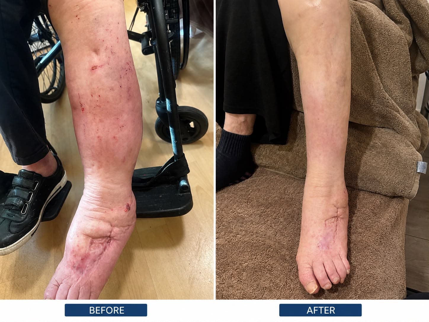 Does Lymphatic Drainage Add to Lymphoedema Care